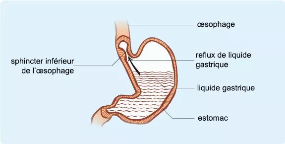 reflux gastro-œsophagien